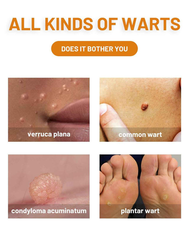 Ximonth Bee Venom Wart & Hidradenitis Suppurativa Treatment Spray, Skin Cleansing Repair Fade Moles Corns Body Care Spray