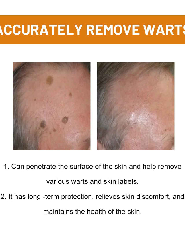 Ximonth Bee Venom Wart & Hidradenitis Suppurativa Treatment Spray, Skin Cleansing Repair Fade Moles Corns Body Care Spray